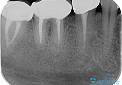 歯冠長延長術・骨隆起除去を行った、スペースの少ないセラミック治療の治療後