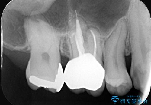 【セラミッククラウン】歯に穴が空いているの治療後