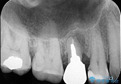 低侵襲なインプラント|痛くないインプラント|エンドペリオ病変|虫歯治療|セラッミクインレーの治療前
