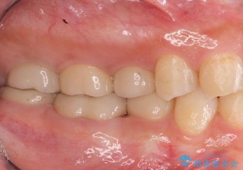 歯冠長延長術・骨隆起除去を行った、スペースの少ないセラミック治療