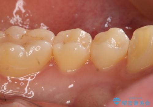 セラミックの被せ物を入れたい フルジルコニアクラウンの治療前