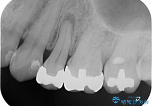 歯ぐきが腫れた　フルジルコニアクラウンの治療前