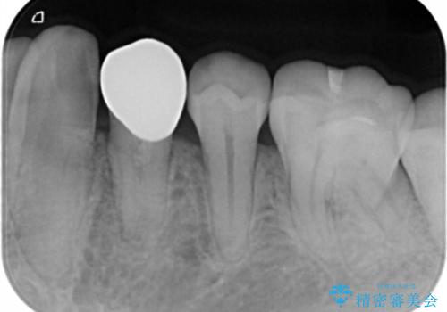 セラミックの被せ物を入れたい フルジルコニアクラウンの治療後