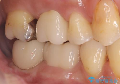 【セラミッククラウン】歯に穴が空いているの治療後