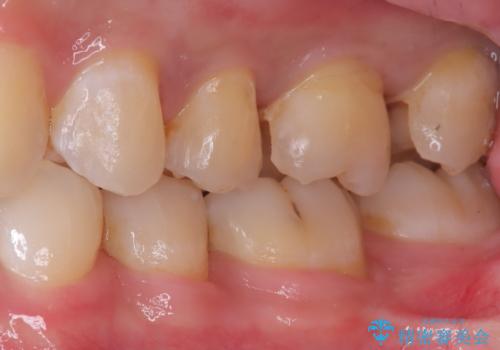 【セラミックインレー】虫歯がないか確認してほしいの治療中