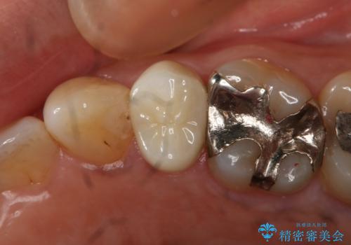 歯ぐきが腫れた フルジルコニアクラウン