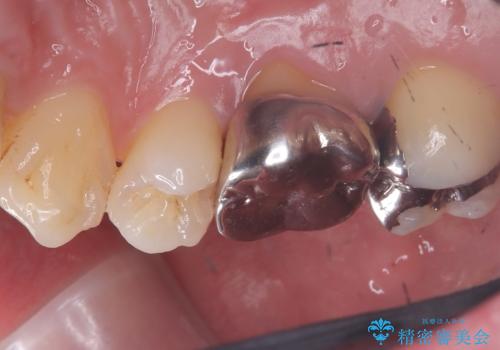 【セラミッククラウン】歯に穴が空いているの治療前