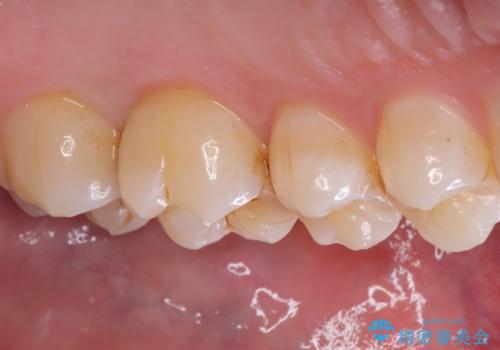 【セラミックインレー】虫歯がないか確認してほしいの治療前