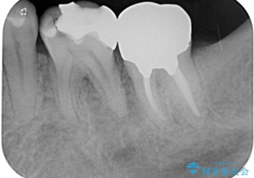ものが噛めないほどの激痛 根管治療とセラミックのむし歯治療の治療前