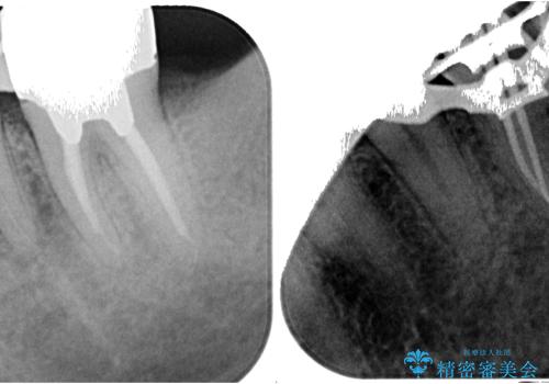 ものが噛めないほどの激痛 根管治療とセラミックのむし歯治療の治療中