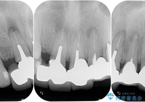 不具合の多い前歯 オールセラミックブリッジ治療の治療前