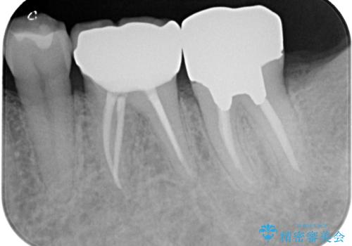 ものが噛めないほどの激痛 根管治療とセラミックのむし歯治療の治療後