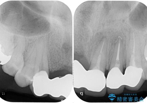 不具合の多い前歯 オールセラミックブリッジ治療の治療後