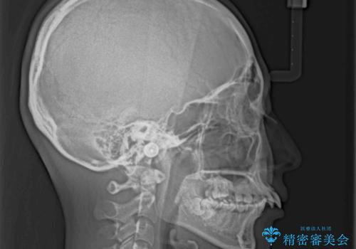 飛び出した前歯　抜歯矯正で横顔が劇的変化の治療前