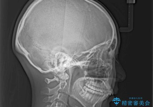 下唇に前歯が引っかかる　インビザライン矯正でスッキリした口元にの治療前