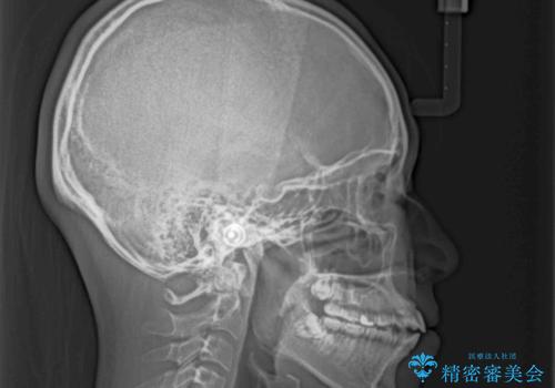 横顔の印象を変えたい ワイヤー装置での抜歯矯正の治療前