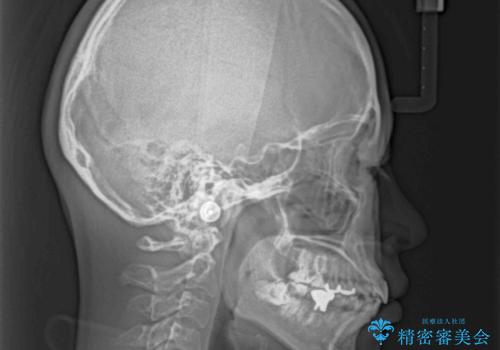 出っ歯と奥歯のむし歯 ワイヤー装置での抜歯矯正とセラミック治療の治療前