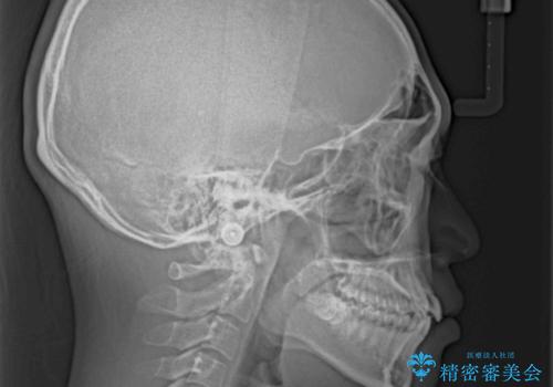 【モニター】デコボコ前歯をワイヤー装置での抜歯矯正で改善の治療前