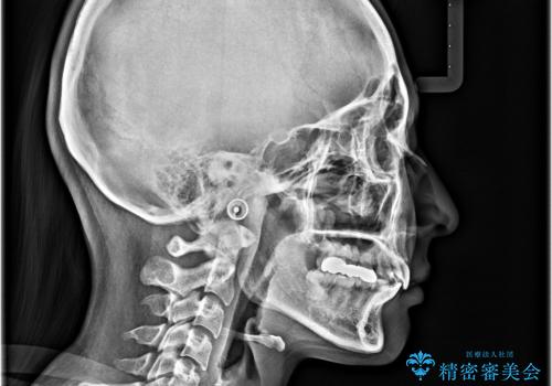 飛び出した前歯 抜歯矯正で横顔が劇的変化の治療後