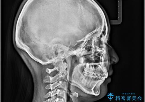 下唇に前歯が引っかかる　インビザライン矯正でスッキリした口元にの治療後