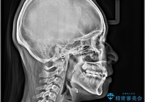 横顔の印象を変えたい ワイヤー装置での抜歯矯正の治療後
