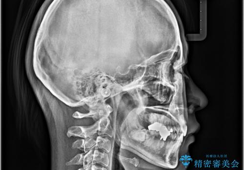 出っ歯と奥歯のむし歯 ワイヤー装置での抜歯矯正とセラミック治療の治療後