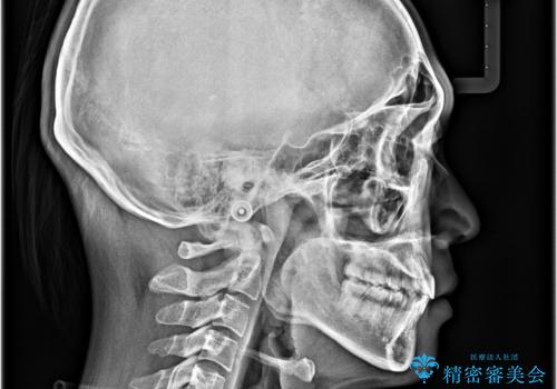 【モニター】デコボコ前歯をワイヤー装置での抜歯矯正で改善の治療後