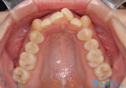 八重歯を改善 ワイヤー装置での抜歯矯正の治療前