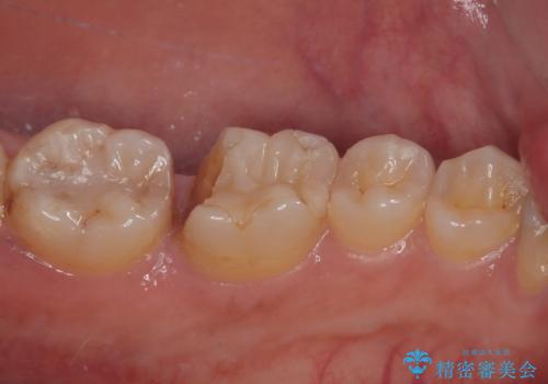 詰め物が割れたのでやり替えたい オールセラミッククラウンの治療前