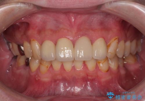 前歯の見た目を良くしたい オールセラミッククラウンの治療後