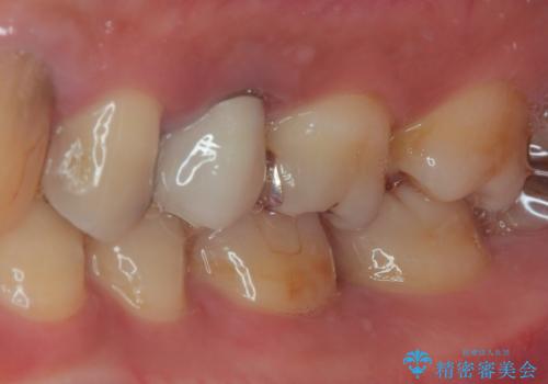 詰め物が割れたのでやり替えたい オールセラミッククラウンの治療前