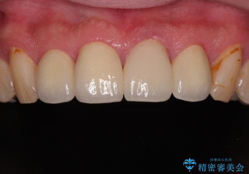 前歯の見た目を良くしたい オールセラミッククラウンの症例 治療後