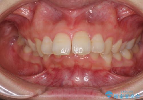 飛び出した前歯 抜歯矯正で横顔が劇的変化の治療前