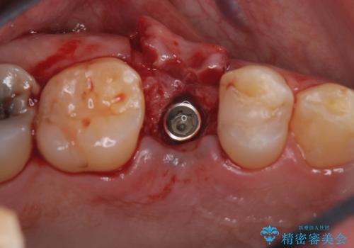 低侵襲なインプラント|痛くないインプラント|エンドペリオ病変|虫歯治療|セラッミクインレーの治療中
