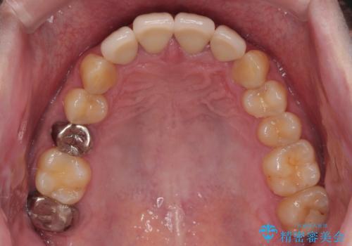 前歯の見た目を良くしたい オールセラミッククラウンの治療後