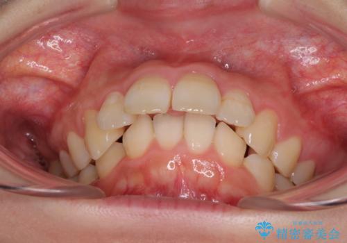 飛び出した前歯 抜歯矯正で横顔が劇的変化の治療前