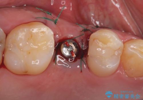 低侵襲なインプラント|痛くないインプラント|エンドペリオ病変|虫歯治療|セラッミクインレーの治療中