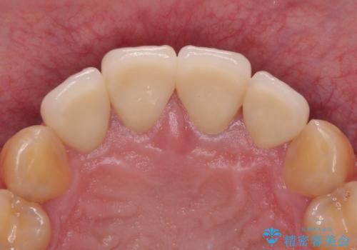前歯の見た目を良くしたい オールセラミッククラウンの治療後