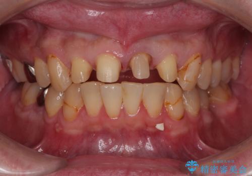 前歯の見た目を良くしたい オールセラミッククラウンの治療中