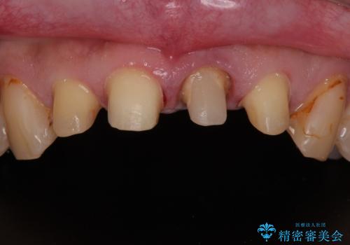 前歯の見た目を良くしたい オールセラミッククラウンの治療中