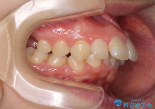 飛び出した前歯 抜歯矯正で横顔が劇的変化の治療前
