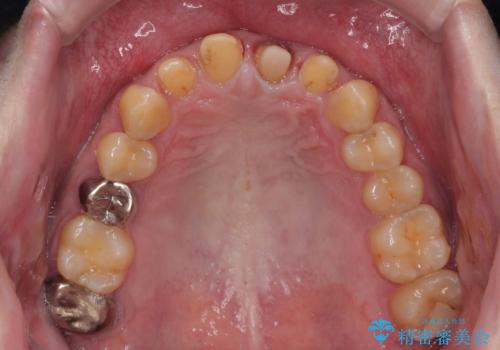 前歯の見た目を良くしたい オールセラミッククラウンの治療中