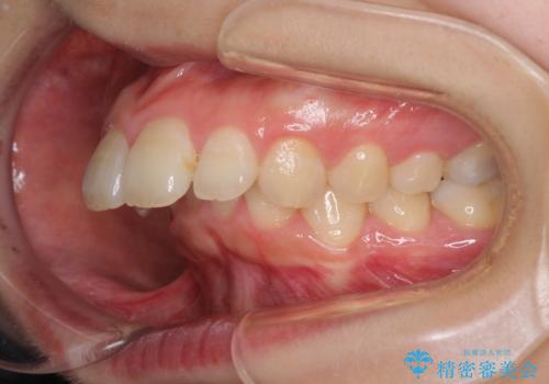 飛び出した前歯 抜歯矯正で横顔が劇的変化の治療前
