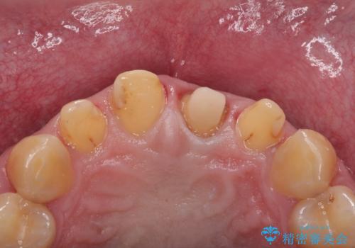 前歯の見た目を良くしたい オールセラミッククラウンの治療中