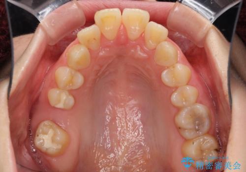 飛び出した前歯　抜歯矯正で横顔が劇的変化の治療前