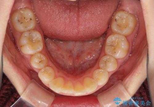 飛び出した前歯 抜歯矯正で横顔が劇的変化の治療前