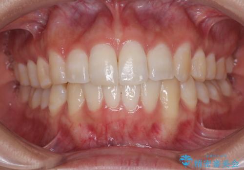 前歯のデコボコを治したい インビザライン矯正の症例 治療後