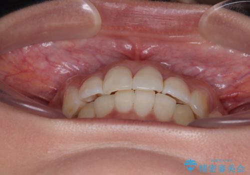 前歯のデコボコを治したい インビザライン矯正の治療後