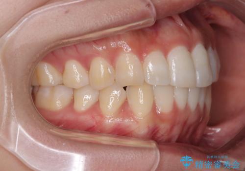 前歯のデコボコを治したい インビザライン矯正の治療後