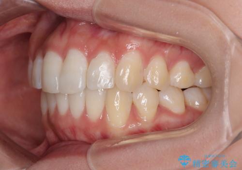 前歯のデコボコを治したい インビザライン矯正の治療後